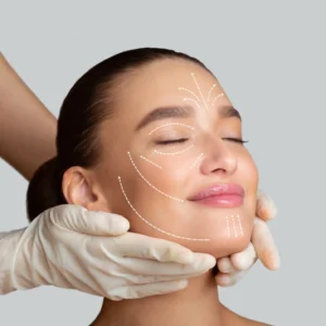 Sculptra facial treatment illustration showing collagen stimulation and skin lifting areas on woman’s face