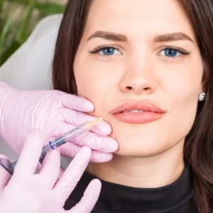 Juvederm for Lips